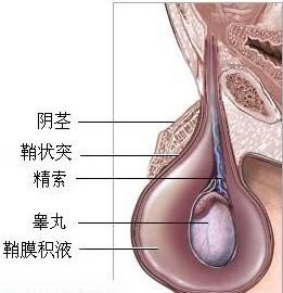 什么是鞘膜积液?得了鞘膜积液怎么办?