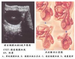 什么是鞘膜积液?得了鞘膜积液怎么办?